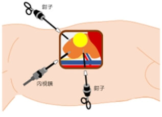 腹腔鏡下手術について