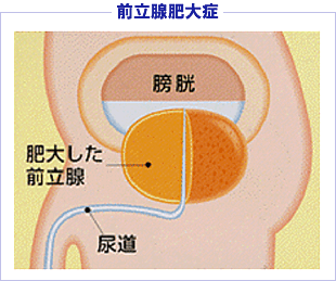 前立腺肥大症9