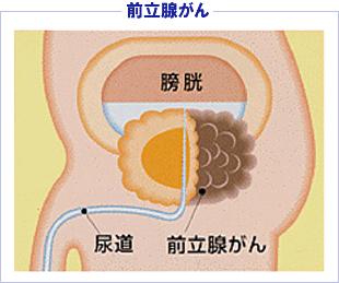 前立腺肥大症10