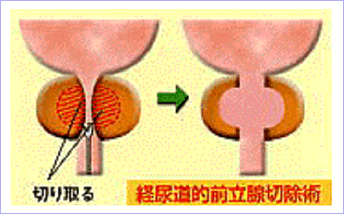 前立腺肥大症13