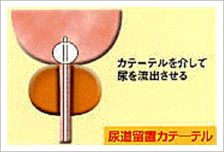 前立腺肥大症19