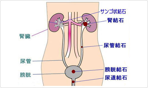 尿路結石